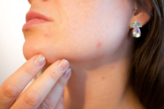 How Addressing Your Gut Can Help With Your Acne